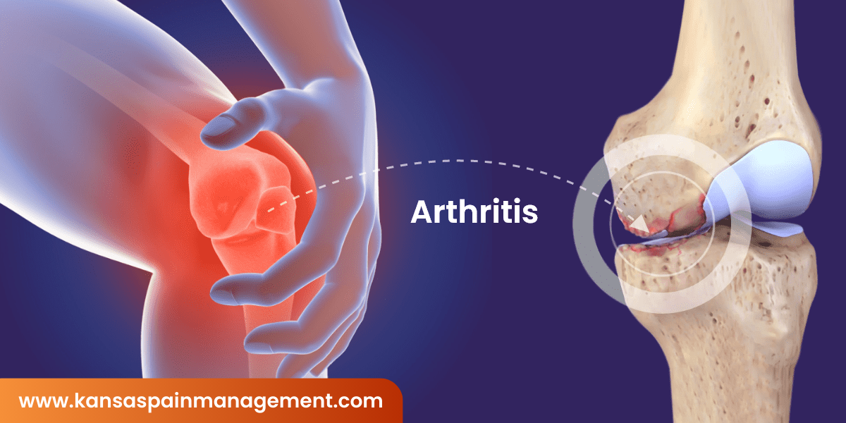 Arthritis
